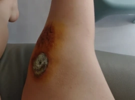 福建某女士：伤口出现疑似霉变，遵从网友建议，决定紧急夜间就医！-创优资源分享网