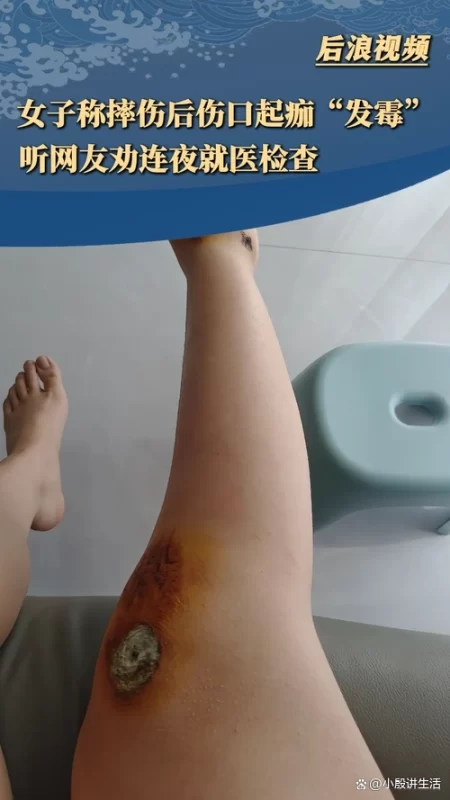 图片[1]-福建某女士：伤口出现疑似霉变，遵从网友建议，决定紧急夜间就医！-创优资源分享网