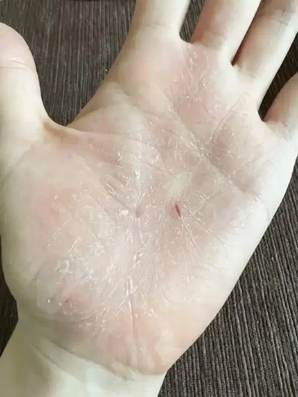 图片[3]-张靓颖公布，最新的健康检查发现她面临营养不良的状况：她的手部皮肤出现了出血点。-创优资源分享网