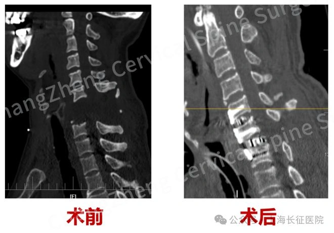 图片[3]-我国医疗队伍成功救治一例罕见“头身分离”病例-创优资源分享网