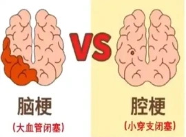 45岁三甲医院脑梗治疗专家不幸罹患脑梗疾病-创优资源分享网