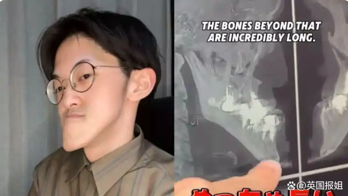 图片[2]-日本男子因“世界最长下巴”而名声大噪：从自卑走向网络红人的蜕变-创优资源分享网