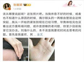 张靓颖公布，最新的健康检查发现她面临营养不良的状况：她的手部皮肤出现了出血点。-创优资源分享网